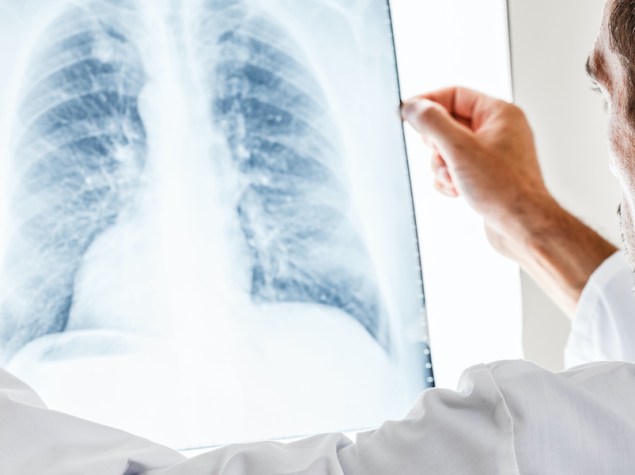 medico che tiene in mano una lastra di polmoni