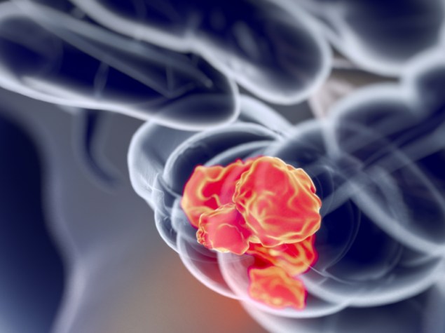 immagine di una radiografia mostrante un tumore localizzato al colon