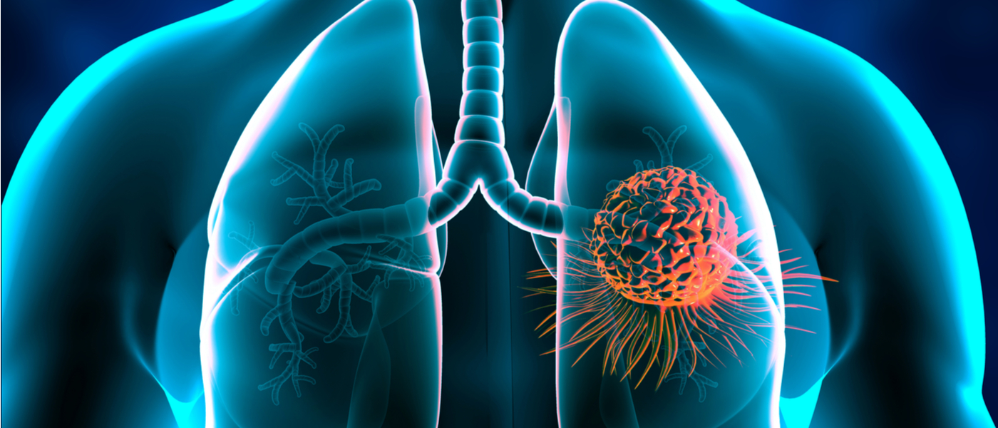 Relazioni tra cancro del polmone e microbioma respiratorio - MSD | Salute