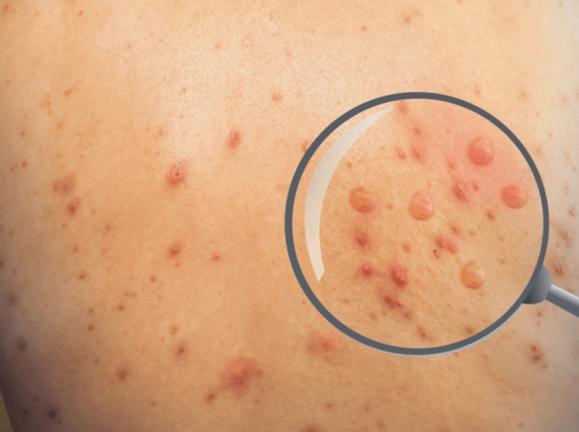 vaiolo delle scimmie