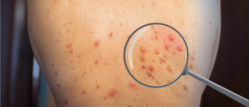 vaiolo delle scimmie