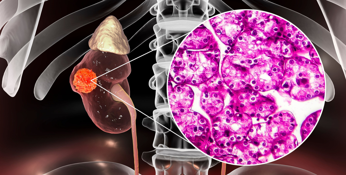 Update Sul Ruolo Del Pembrolizumab Nei Carcinoma Renale - MSD | Salute