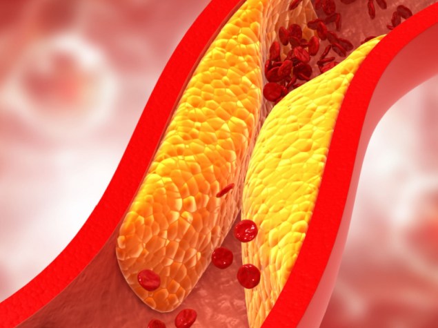 Arteria occlusa colesterolo