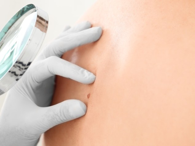 mano di dottore che scruta la pelle della schiena di un paziente