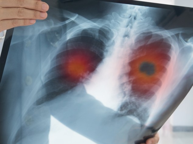 medico che tiene in mano una lastra di polmoni