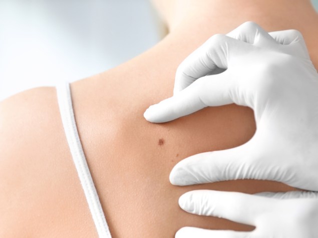dottore che analizza il neo sulla spalla sinistra di una paziente