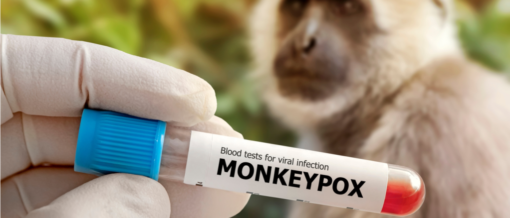 mano con guanto tiene tra le dita provetta con scritta monkeypox