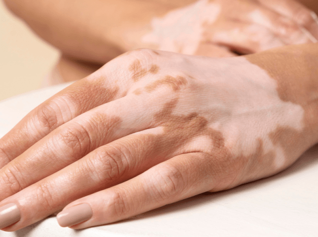 MANO DI PERSONA affetta da Vitiligine