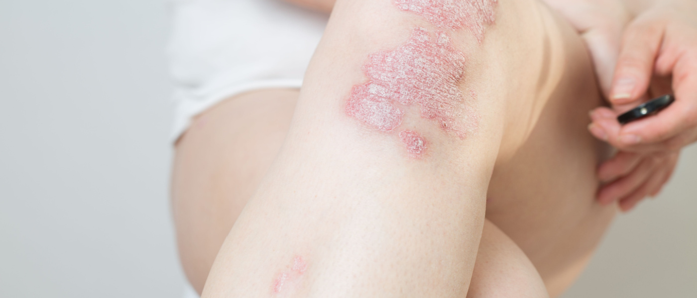 psoriasi gambe pelle irritata dermatite