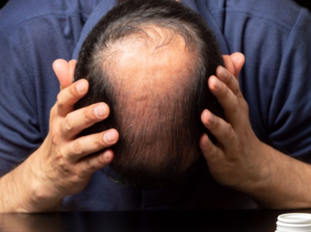 uomo con vistosa alopecia