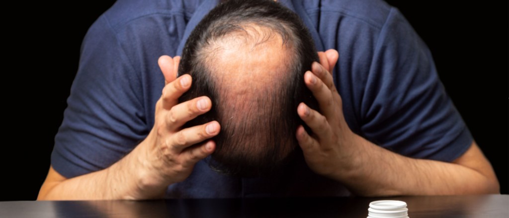 uomo con vistosa alopecia