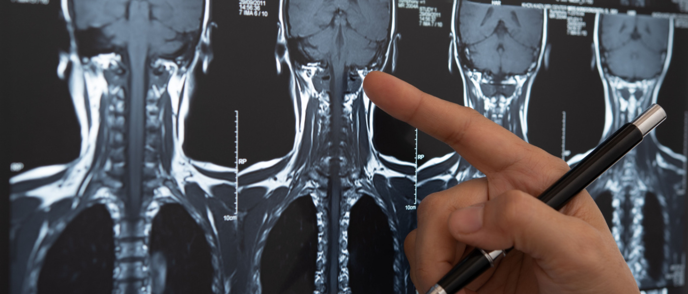 mano di un medico che indica ossa del collo in una lastra radiografica