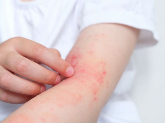 Persona si gratta il braccio con psoriasi