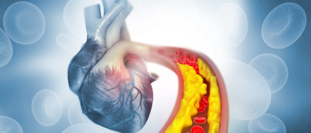 arterie cuore ostruite colesterolo