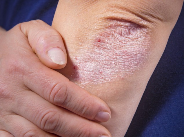 Psoriasi sul gomito di una donna su sfondo scuro. Primo piano