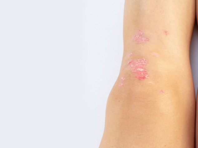 Artrite psoriasica con psoriasi cutanea sulle ginocchia di una donna. Liquido sinoviale in un paziente con psoriasi dell'articolazione del ginocchio sinistro. Artrite infiammatoria che causa gonfiore, arrossamento, dolore e danni alle articolazioni.