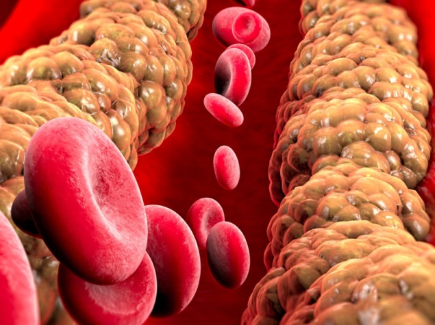 Formazione di colesterolo, grasso, arteria, vena, cuore. Globuli rossi, flusso sanguigno. Restringimento di una vena per la formazione di grasso. Operazione chirurgica, rendering 3d