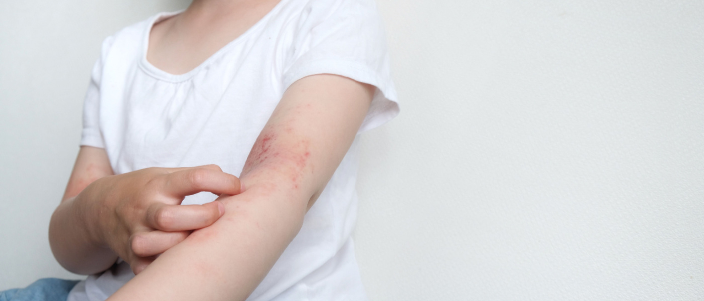Il bambino si gratta la pelle atopica. Dermatite, diatesi, allergia sul corpo del bambino.