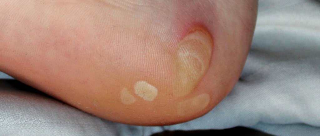 Un caso di epidermolisi bollosa simplex su un piede