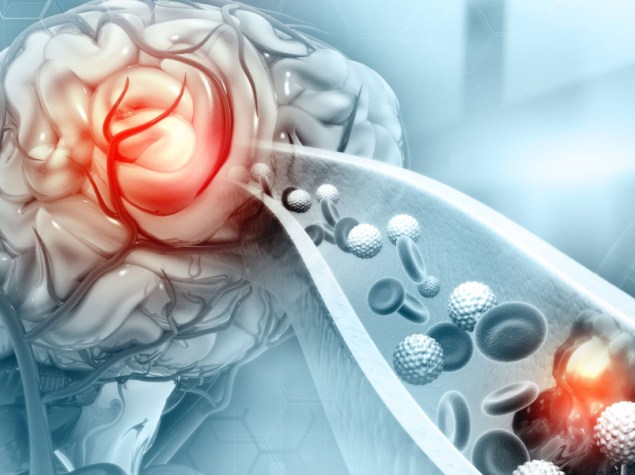 Aterosclerosi Ictus. Coagulo di sangue nei vasi del cervello umano. Illustrazione 3d