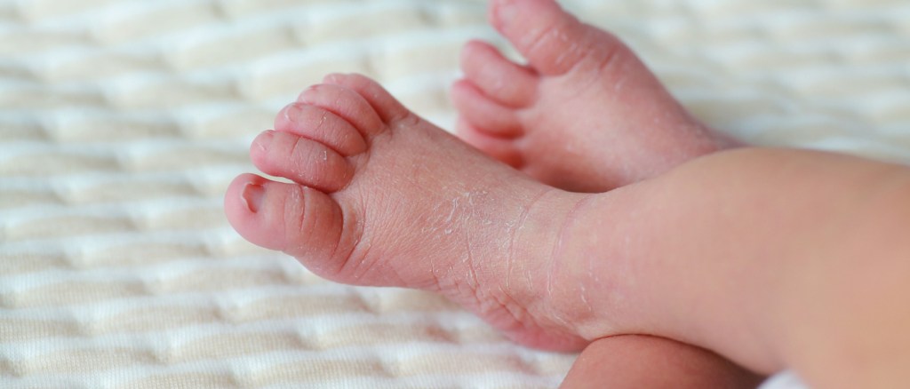 Pelle squamosa da psoriasi sui piedi dei neonati.