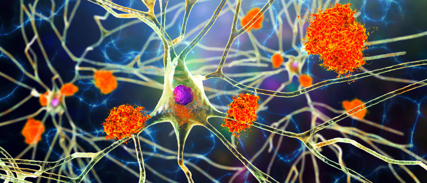 Neuroni nella malattia di Alzheimer. Illustrazione 3D che mostra le placche amiloidi nel tessuto cerebrale, i grovigli neurofibrillari e la distruzione delle reti neuronali.