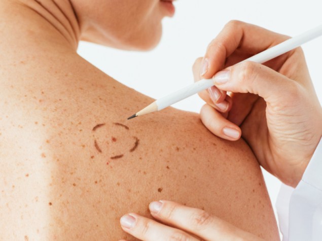 vista ritagliata del dermatologo che applica segni sulla pelle della donna nuda con melanoma isolato su bianco