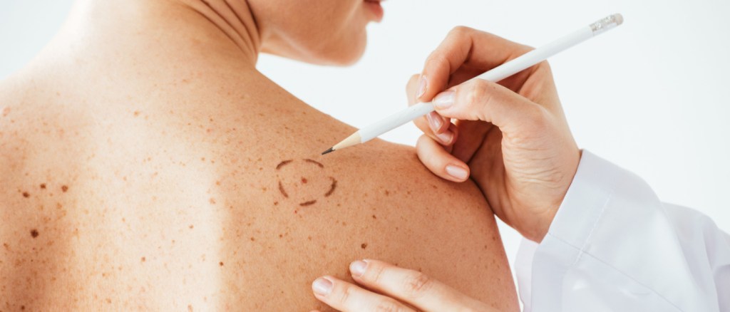 vista ritagliata del dermatologo che applica segni sulla pelle della donna nuda con melanoma isolato su bianco