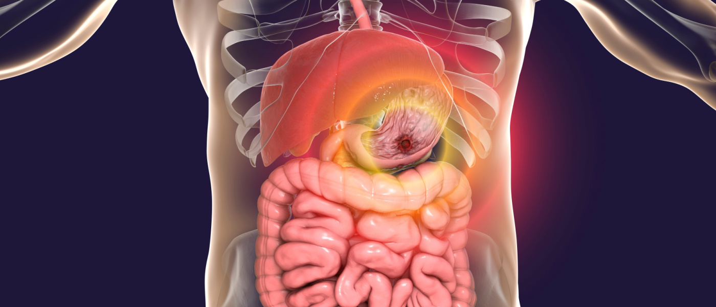 Peptic ulcer, 3D illustration showing an ulcer on the stomach surface