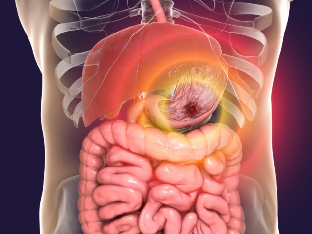 Peptic ulcer, 3D illustration showing an ulcer on the stomach surface