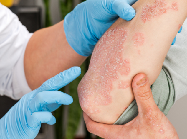 medico che effettua vuisita sulla psoriasi sul braccio di un paziente