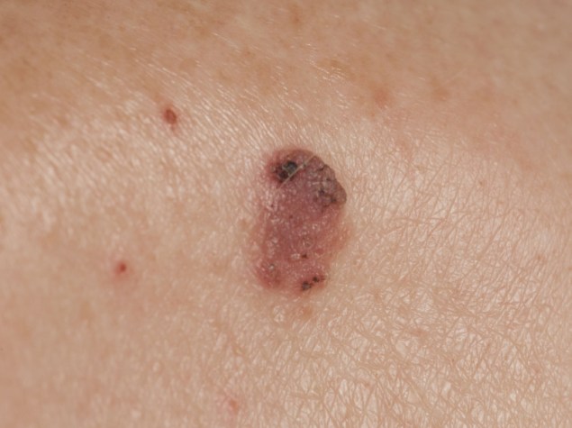 ingrandimento di un neo maligno sulla pelle