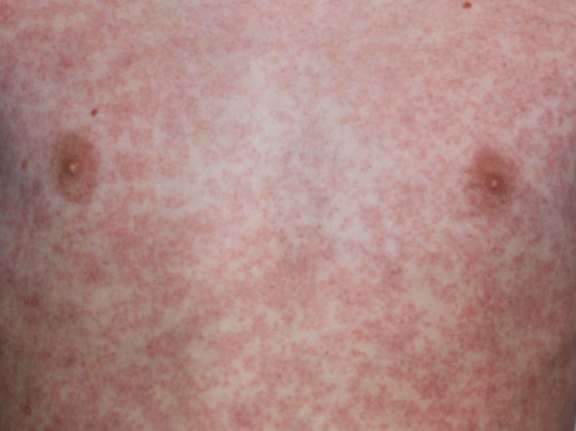 uomo con segni di morbillo sul petto