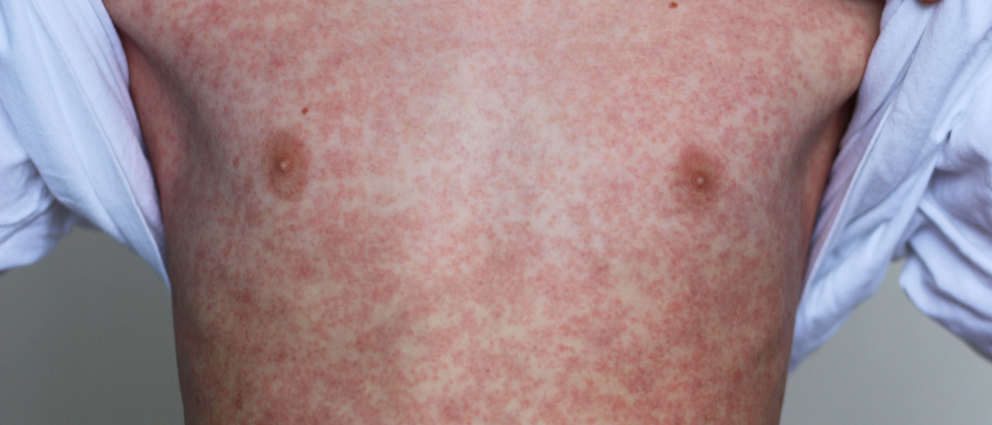 uomo con segni di morbillo sul petto