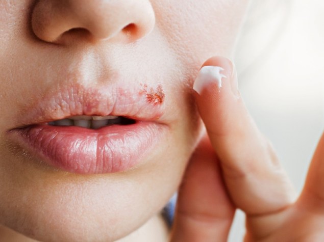 Donna spalma crema sull'herpes labbiale
