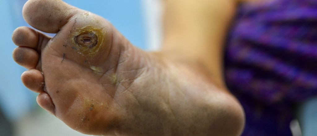 close up su un piede con ulcera diabetica