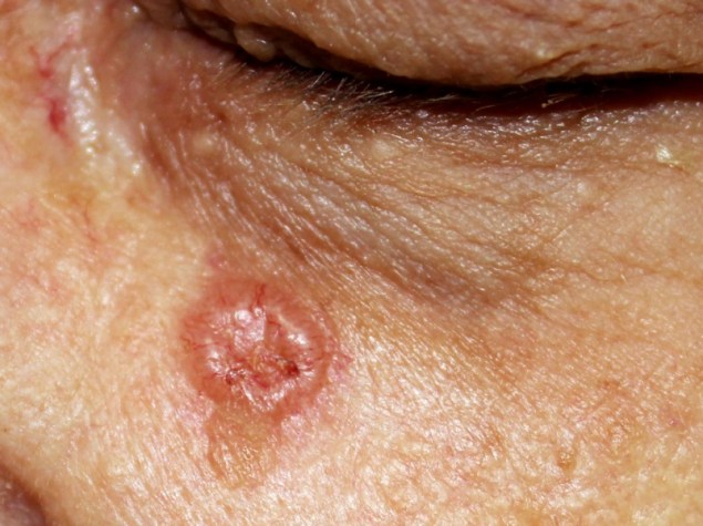 Viso di paziente anziano che presenta un arcinoma a cellule basali