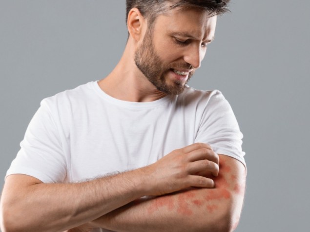 uomo con dermatite sul braccio