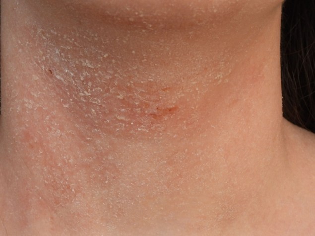 collo di donna con dermatite atopica