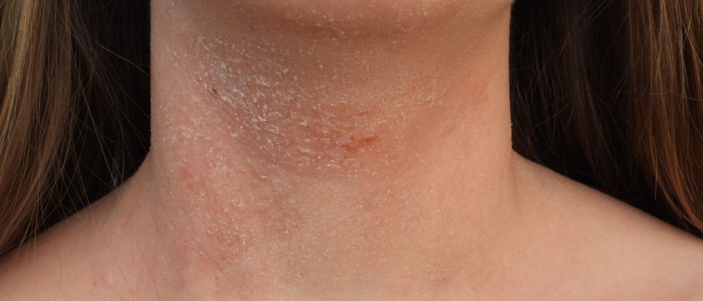 collo di donna con dermatite atopica