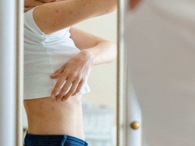 Donna con psoriasi si guarda allo specchio