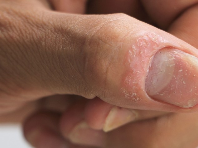 unghia con psoriasi