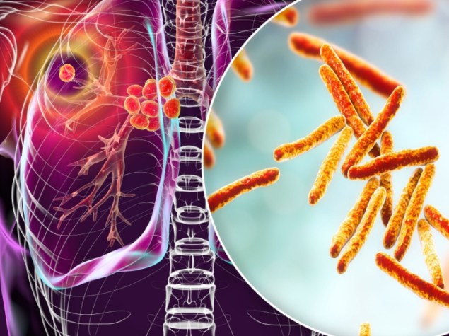 Polmoni e virus tubercolosi