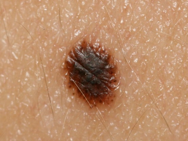 Un caso di nevo di Spitz pigmentato