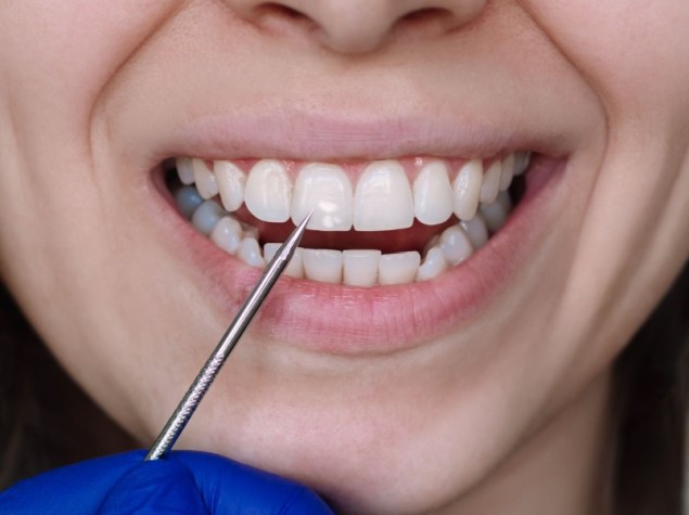 Donna che mostra i denti ad un dentista