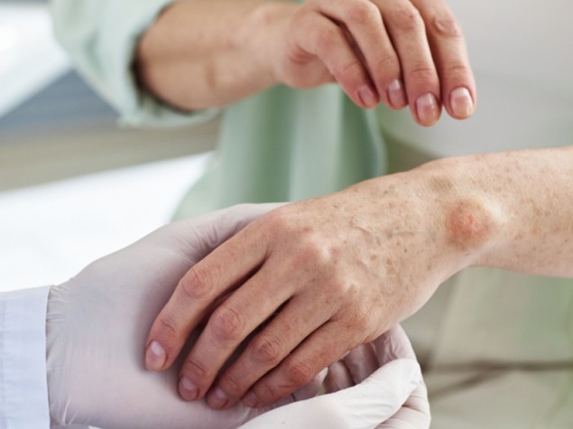 Medico visita paziente con dermatite su mano