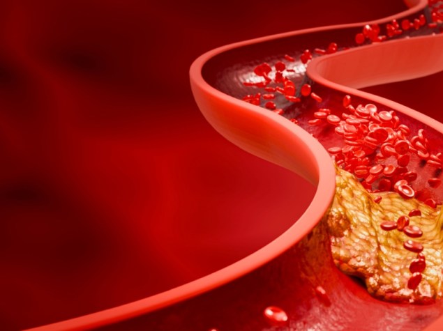 immagine arteria occlusa