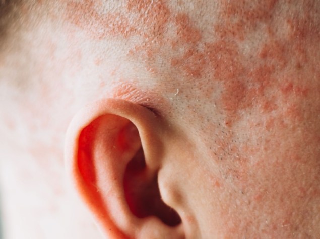 Testa uomo con psoriasi