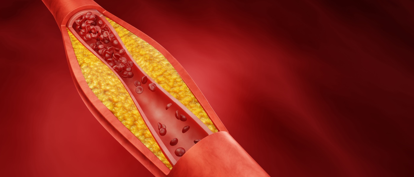 Immagine 3d di un'arteria ostruita