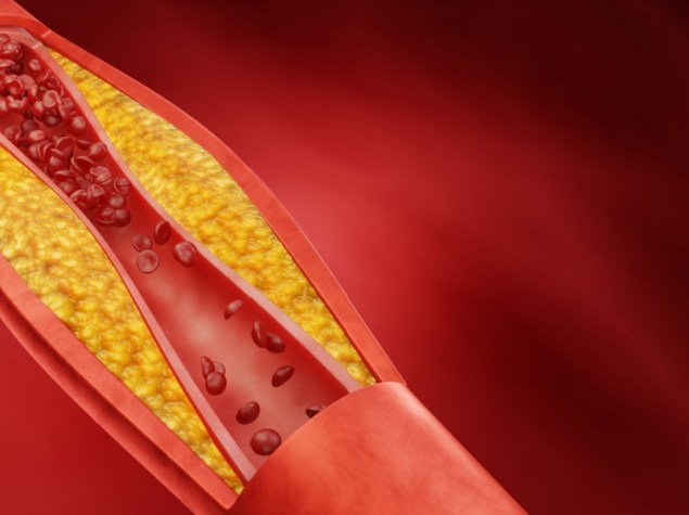 Immagine 3d di un'arteria ostruita